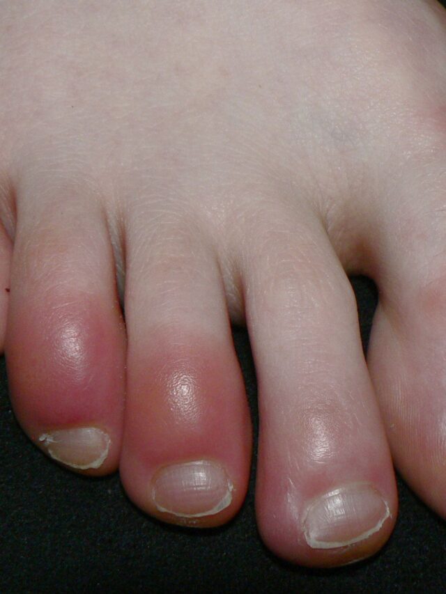 ਕੀ ਸਰਦੀ ਦੇ ਵਿੱਚ ਤੁਹਾਨੂੰ ਵੀ ਇਹ ਸਮੱਸਿਆ ਆਉਂਦੀ ਹੈ ?